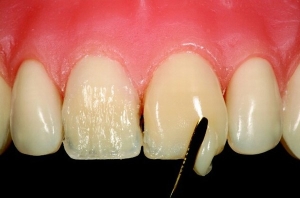 فاصله بین دندانی