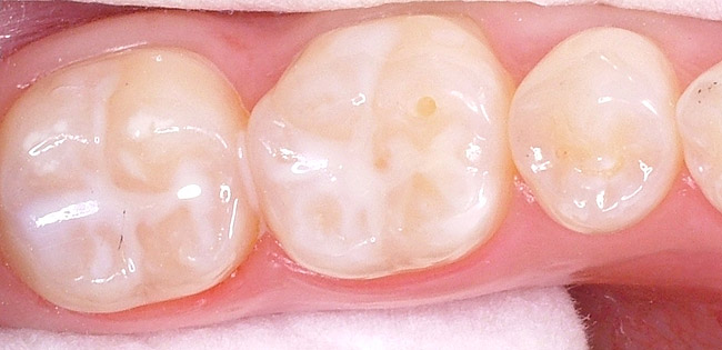 فیشورسیلانت,فیشور سیلانت,پیشگیری از پوسیدگی دندان