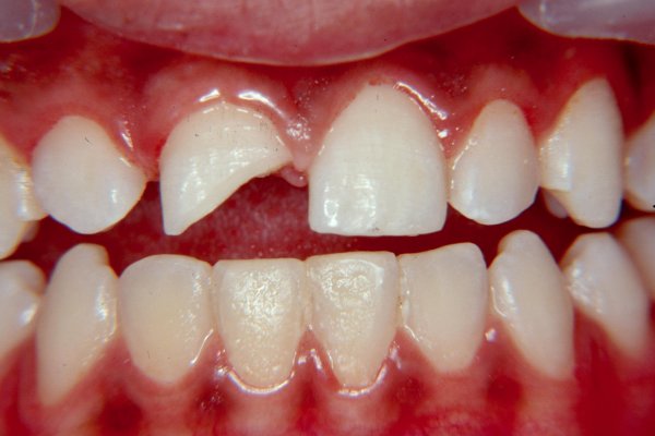 شکستگی دندان