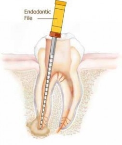 عصب کشی دندان عقل,عصب کشی,درمان کانال ریشه