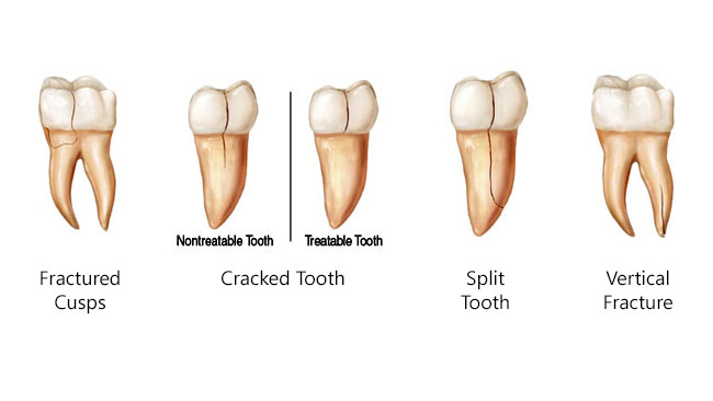 شکستن عمودی دندان,ایمپلنت,پروتز دندانی