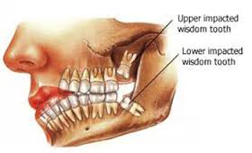 عصب کشی دندان عقل,عصب کشی,درمان کانال ریشه