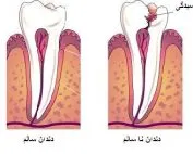 پوسیدگی دندان