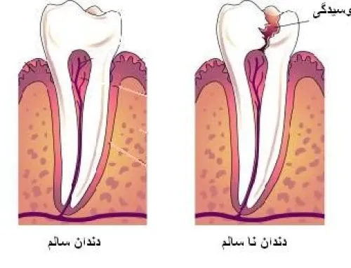 لبخند زیبا بدون داشتن پوسیدگی دندان
