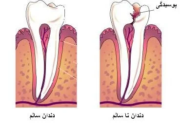 پوسیدگی دندان
