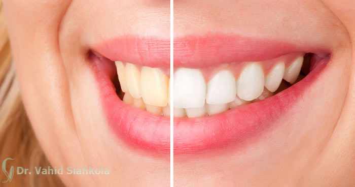 سفید کردن دندان,بلیچینگ,علت زردی دندان