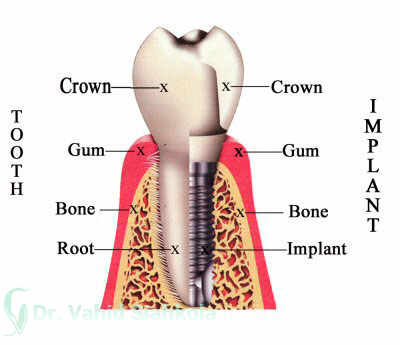 اجزای ایمپلنت دندان,ایمپلنت