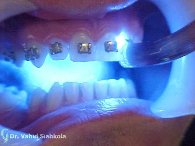 پر کردن دندان با اشعه