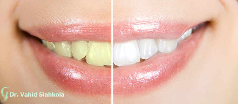 بلیچینگ دندان,سفید کردن دندان