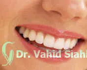 هرچیزی که درباره لامینت باید بدانید!