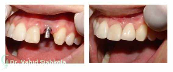 زیبایی دندان,ایمپلنت دندان