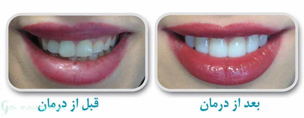 کامپوزیت دندان برای چه کسانی مفید است؟