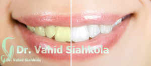 علت اصلی تغییر رنگ دندان ها