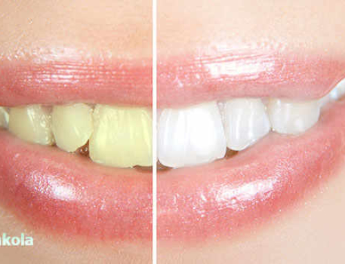 راههای سفید کردن دندان ها و هزینه ی بلیچینگ دندان