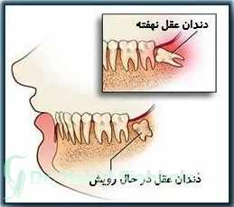 سرنوشت دندان های نهفته چه می شود؟