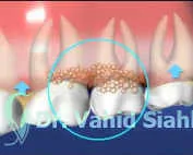 مقصر اصلی تحلیل لثه ها چیست؟