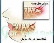 سرنوشت دندان های نهفته چه می شود؟